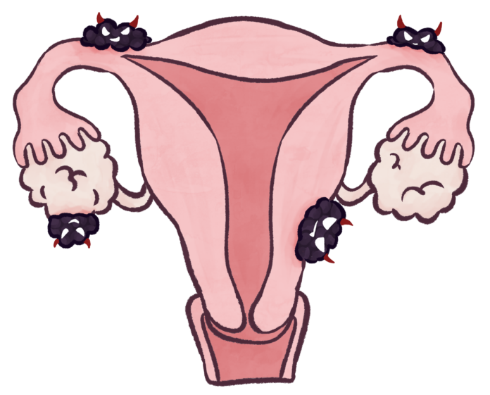 YukiCai-Endometriosis Uterus lined with anthropomorphized endometriosis. The endometriosis has devil horns.