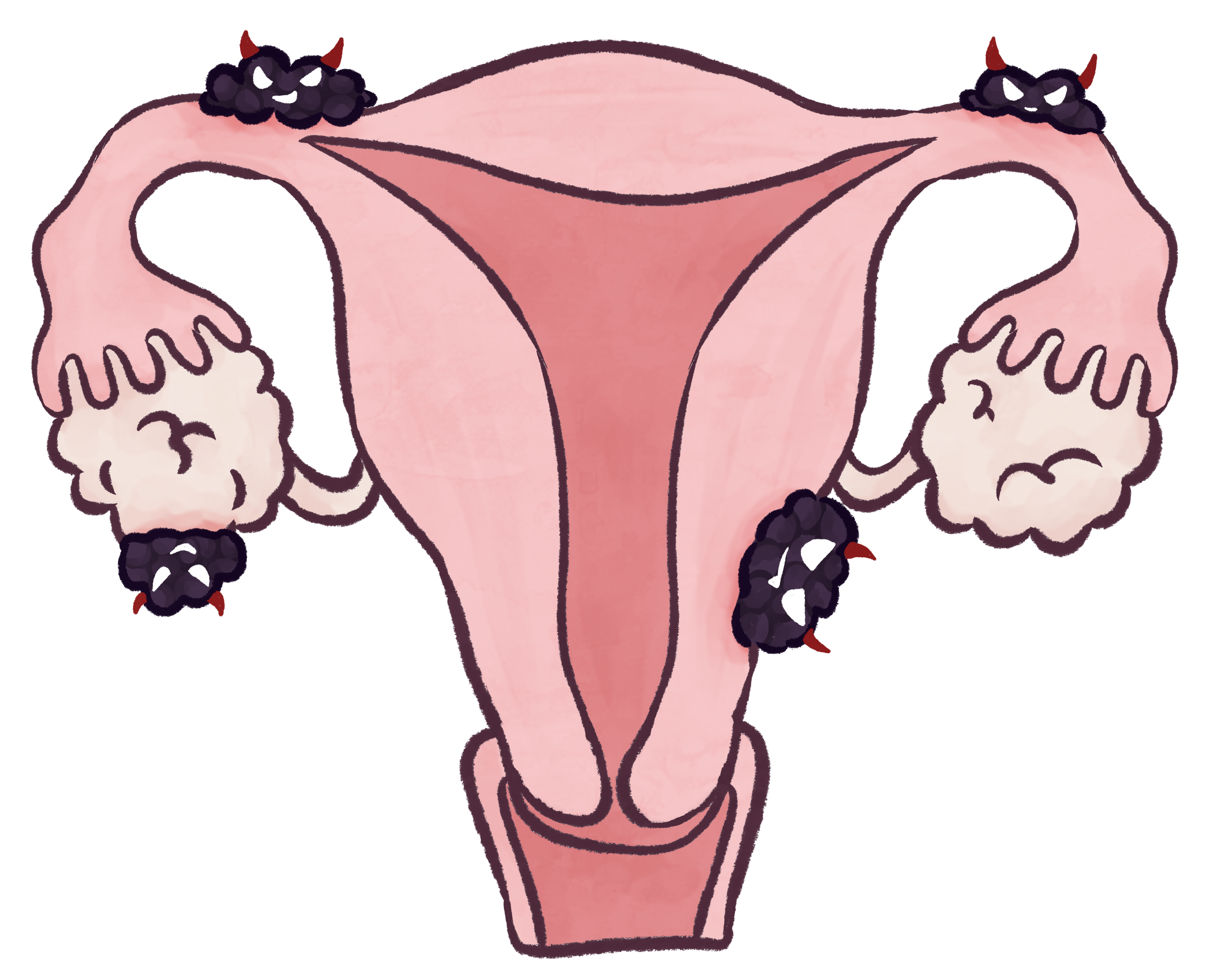 Uterus lined with anthropomorphized endometriosis. The endometriosis has devil horns.
